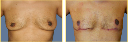 Female to Male Gender Re-assignment Surgery