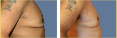 Female to Male Gender Re-assignment Surgery