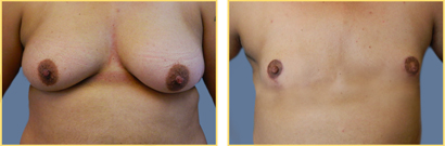 Female to Male Gender Re-assignment Surgery