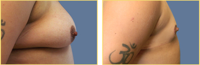 Female to Male Gender Re-assignment Surgery
