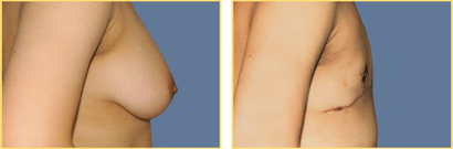 Female to Male Gender Re-assignment Surgery