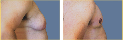 Female to Male Gender Re-assignment Surgery