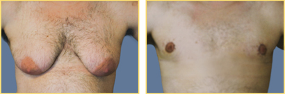 Female to Male Gender Re-assignment Surgery
