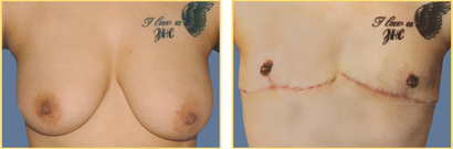 Female to Male Gender Re-assignment Surgery