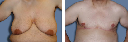 srs-1 Female to Male – Gender Re-assignment Surgery
