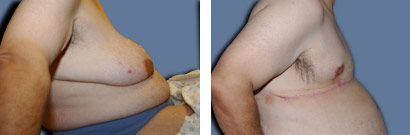 srs-2 Female to Male – Gender Re-assignment Surgery