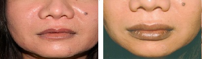 Perma Facial Implant
