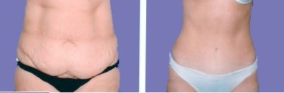 Tummy Tuck Before and After Front