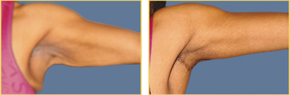 Before and After Brachioplasty