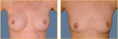 Breast Explantation