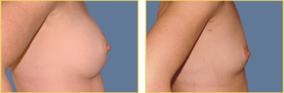 Breast Explantation Surgery