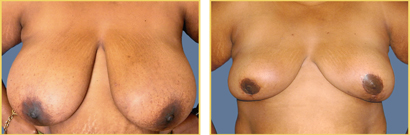 Breast Reduction