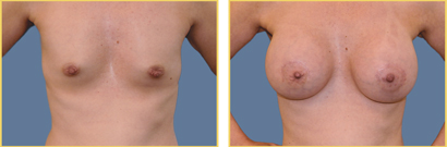 Sientra Augmentation Before and After Sientra Gummy Bear Implants