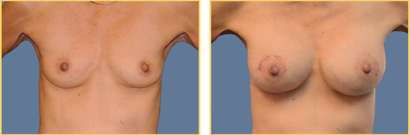 Sientra Augmentation Before and After Sientra Gummy Bear Implants