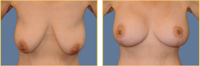 Before and after Mastopexy Augmentation