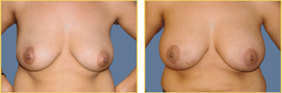 Before and after Mastopexy Augmentation