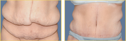 Before and After Post-Bariatric Surgery