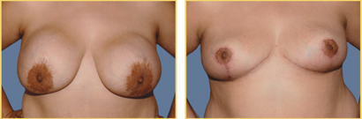 Breast Explanation Surgery