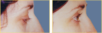Fat Grafting Before and After