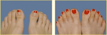 Fat Grafting Before and After