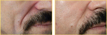 Fat Grafting Before and After