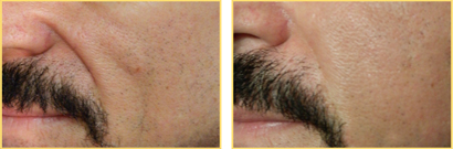 Fat Grafting Before and After