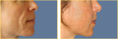 Fat Grafting Before and After