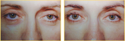 Fat Grafting Before and After