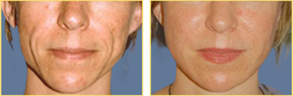 Fat Grafting Before and After