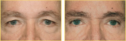 Eyebrows