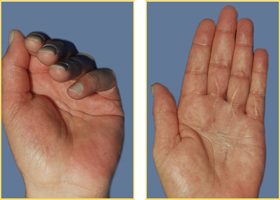 Hand Reconstruction