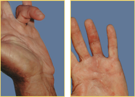 Hand Reconstruction