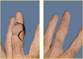 Hand Reconstruction