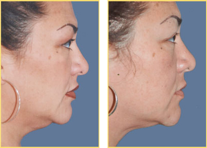 Laser Liposuction