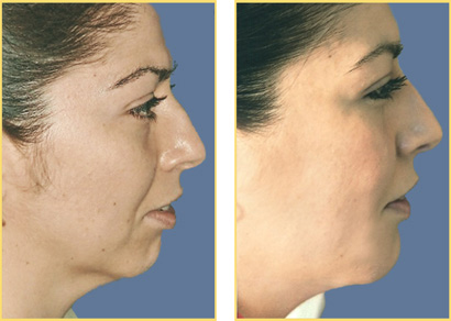 fat-grafting-2