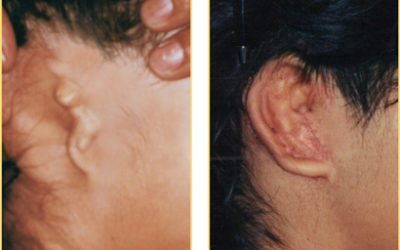 Taking on Microtia Ear