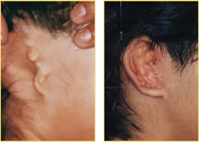 Microtia Ear Repair before and after picture