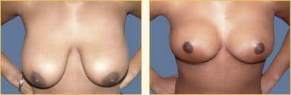 Foto de antes y después de la cirugía de reducción de senos