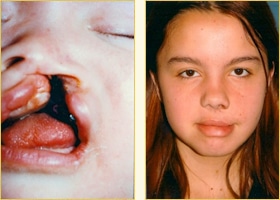 Cleft Lip Surgery – at birth (left) and age 15 (right)