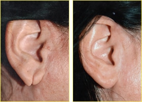 Earlobe Repair Surgery in Orlando