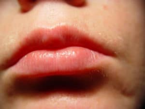 What You Really Need to Know About Lip Augmentation