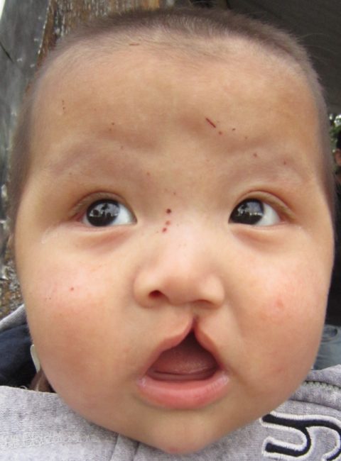 Foto de un bebé con labio y paladar hendido