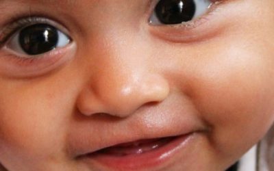 Raising Awareness of Cleft Lip and Palate Throughout the World