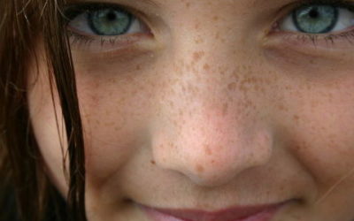 Lip Augmentation as a Reliever for Facial Paralysis