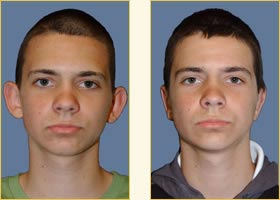 Otoplasty Does Wonders for Young Harvard Boy