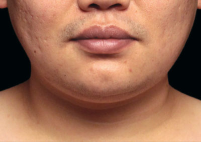 man chin after procedure