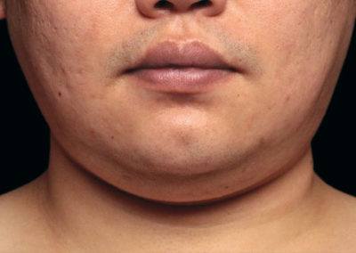 man chin before procedure