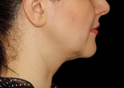 woman face side view after procedure