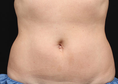 belly coolsculpting after treatment