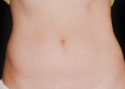 belly coolsculpting after treatment